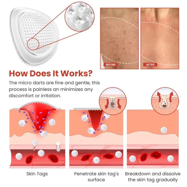 Derma Smooth Skin Tag Removal Patch | 72 Pathces |